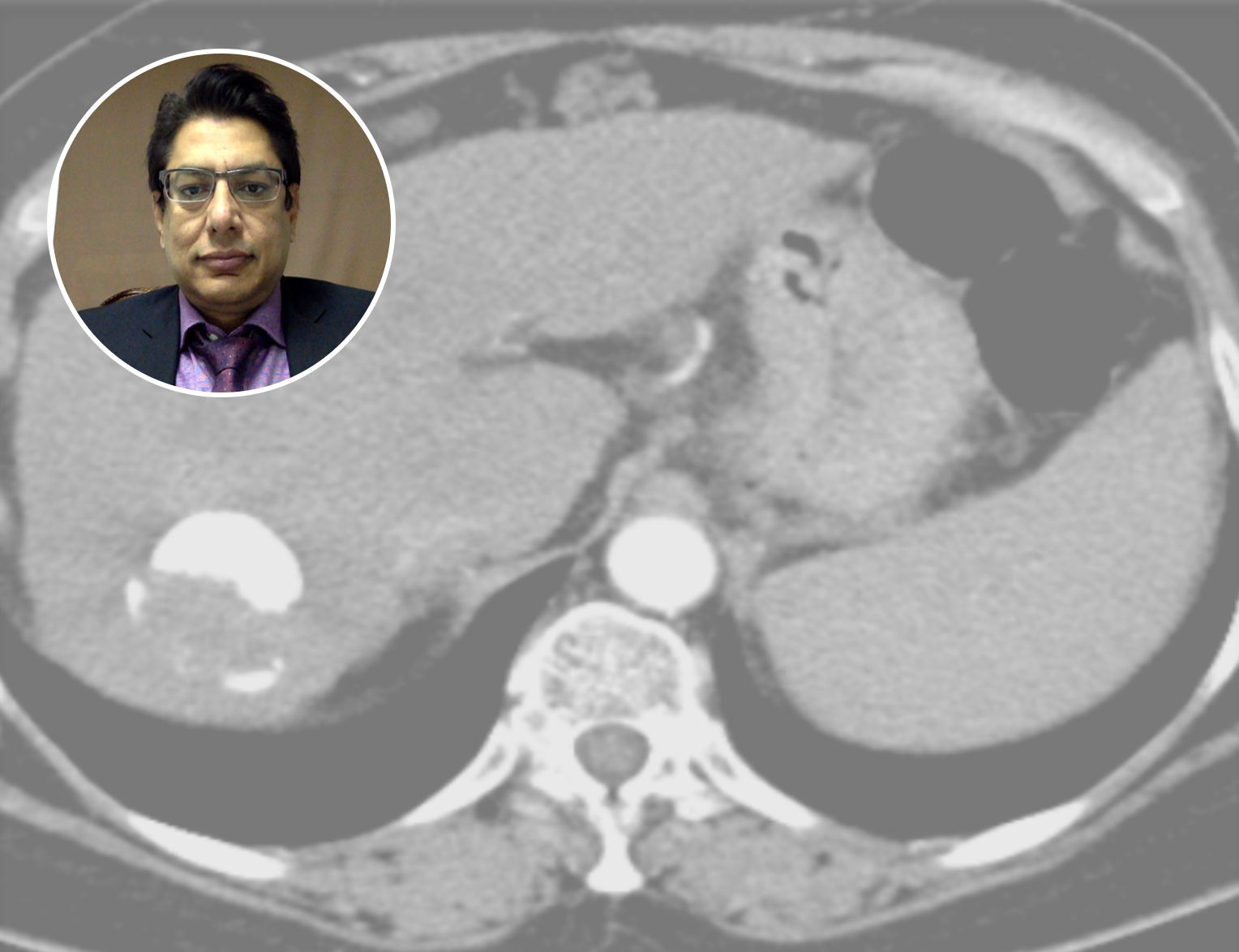 Combination Therapy with TACE and Microwave Ablation to